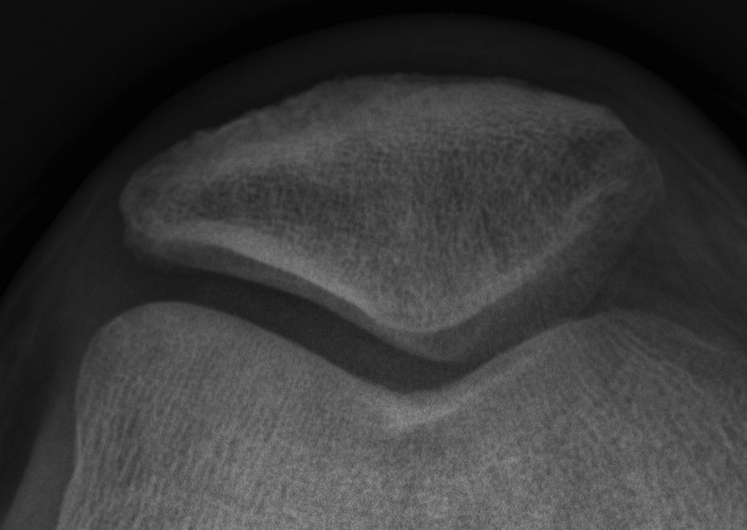Patella Medial and Lateral Facets